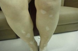 腿部白癜风难以治疗的原因有哪些