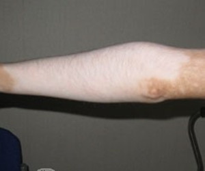 肢端型白癜风给患者带来哪些危害